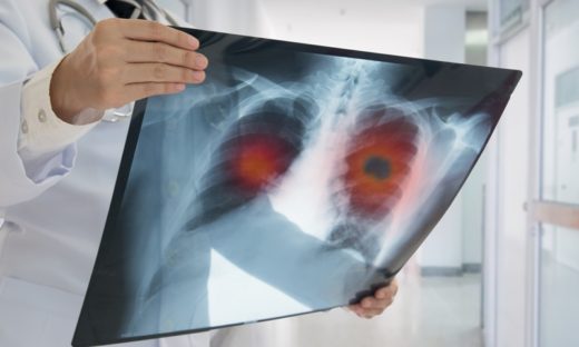 Tumore al polmone: una terapia riduce dell’84% il rischio di morte