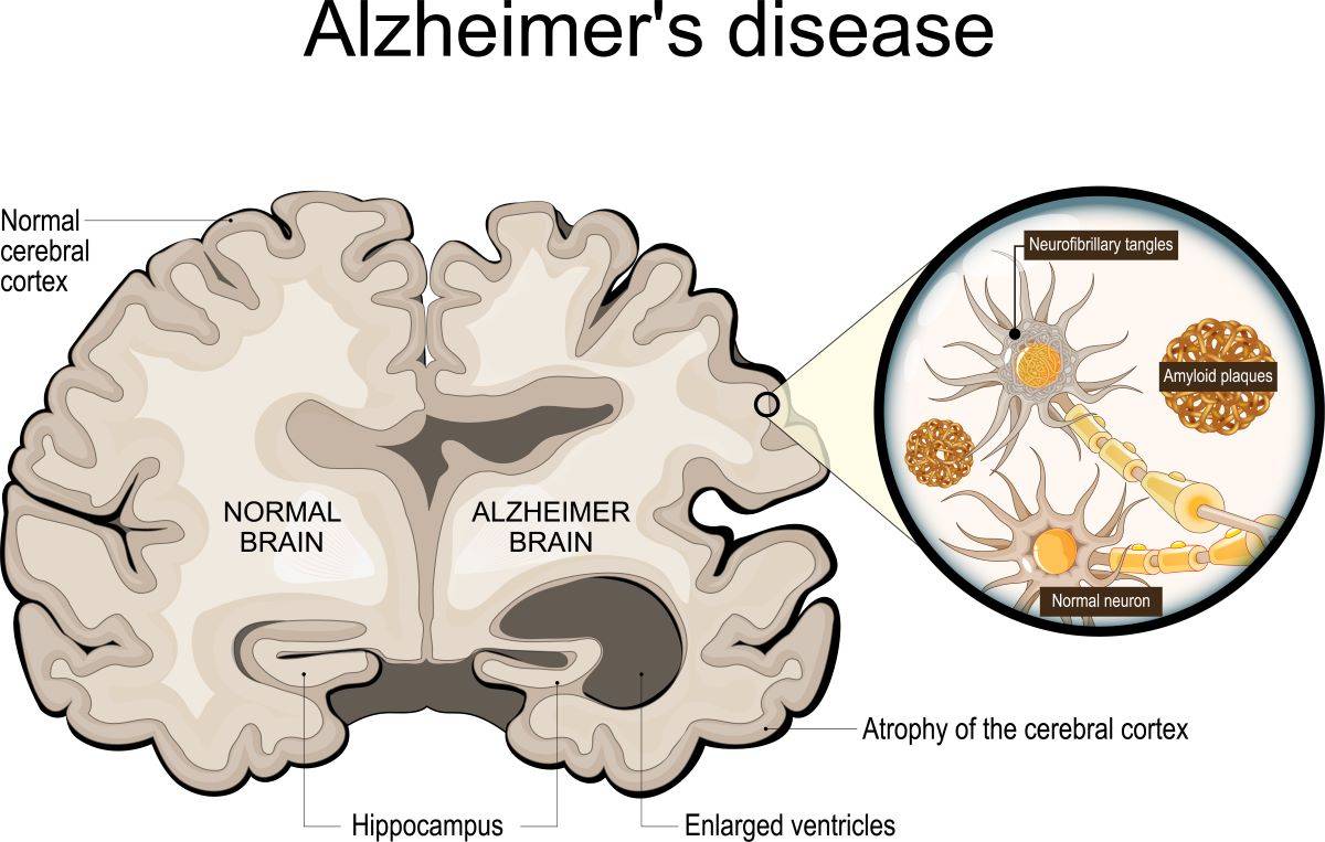 alzheimer